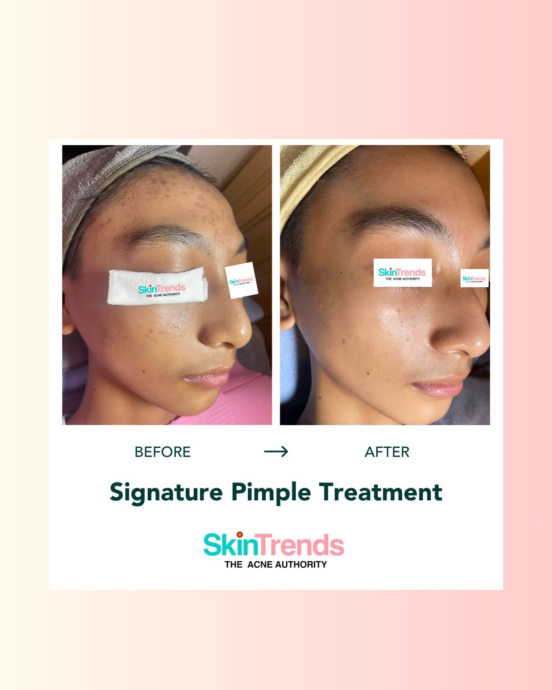 Skin Trends Signature Pimple Treatment before and after — visible improvement in skin clarity and texture after professional acne treatment